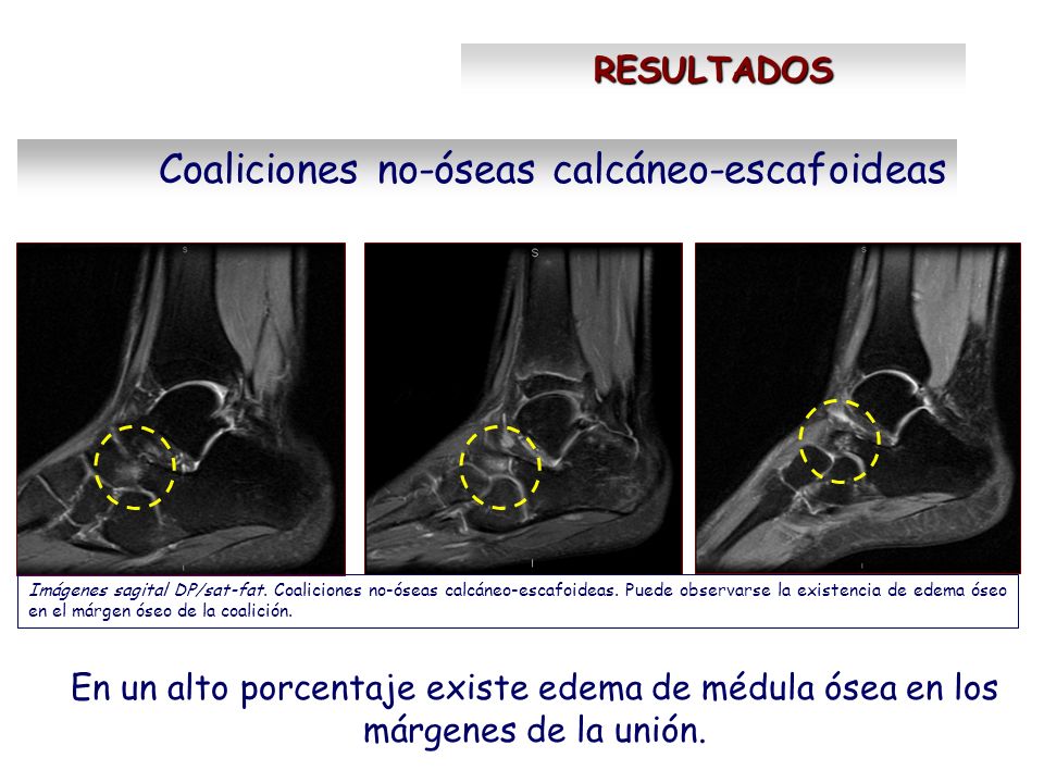 Significa oseo que edema